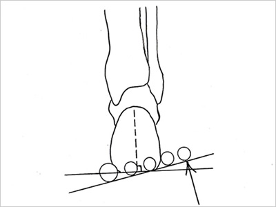 前足部外反 fore foot valgus