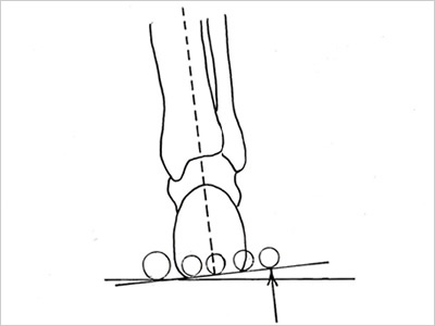 後足部外反 rear foot valgus