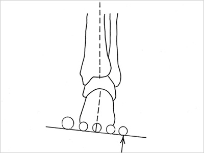 後足部内反 rear foot varus