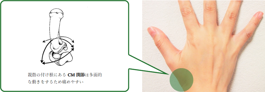 親指の付け根にあるCM関節は多面的な動きをするために痛めやすい